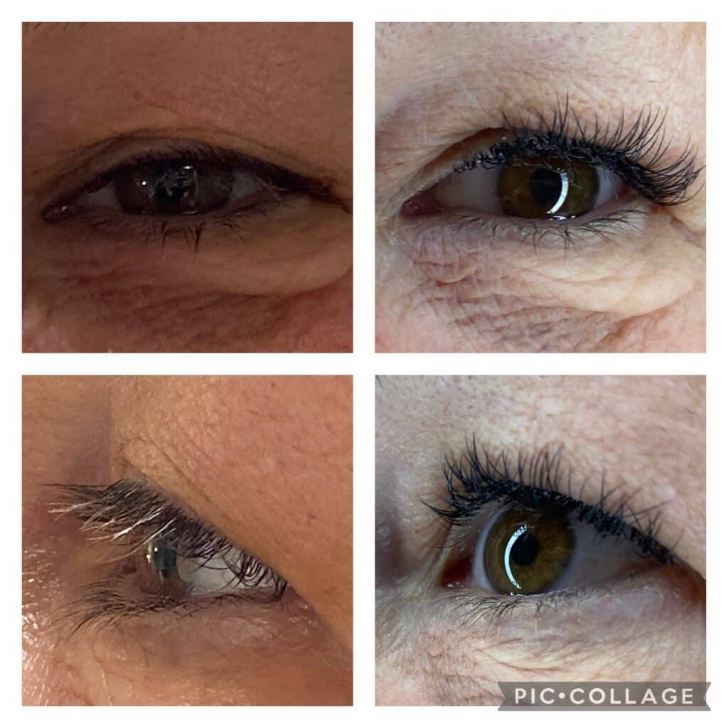 Medical Spa In Nixa MO Before And After 5