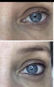 Medical Spa In Nixa MO Before And After Permanent Makeup 1