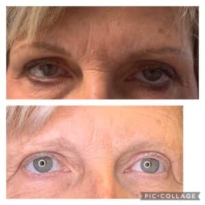 Medical Spa In Nixa MO Before And After Permanent Makeup 2