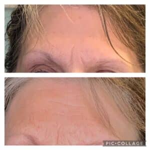 Medical Spa In Nixa MO Before And After Permanent Makeup Plasma 2