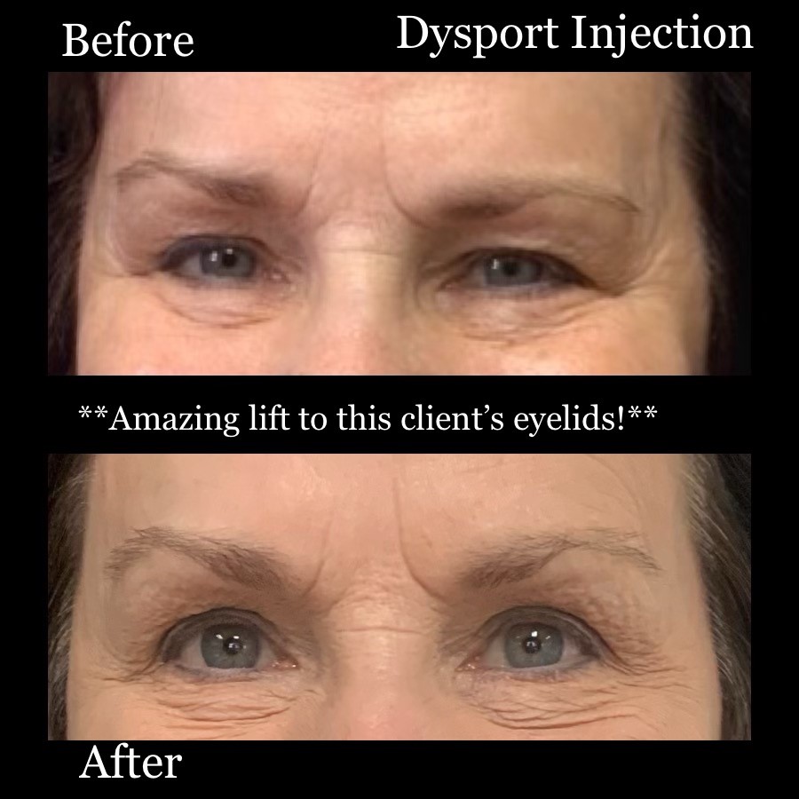 Before And After Dysport Injection