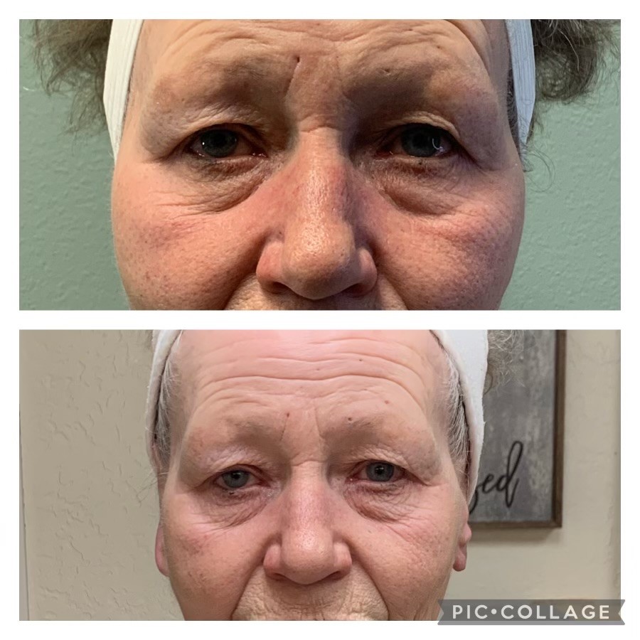 Before And After Plasma Skin Tightening 2