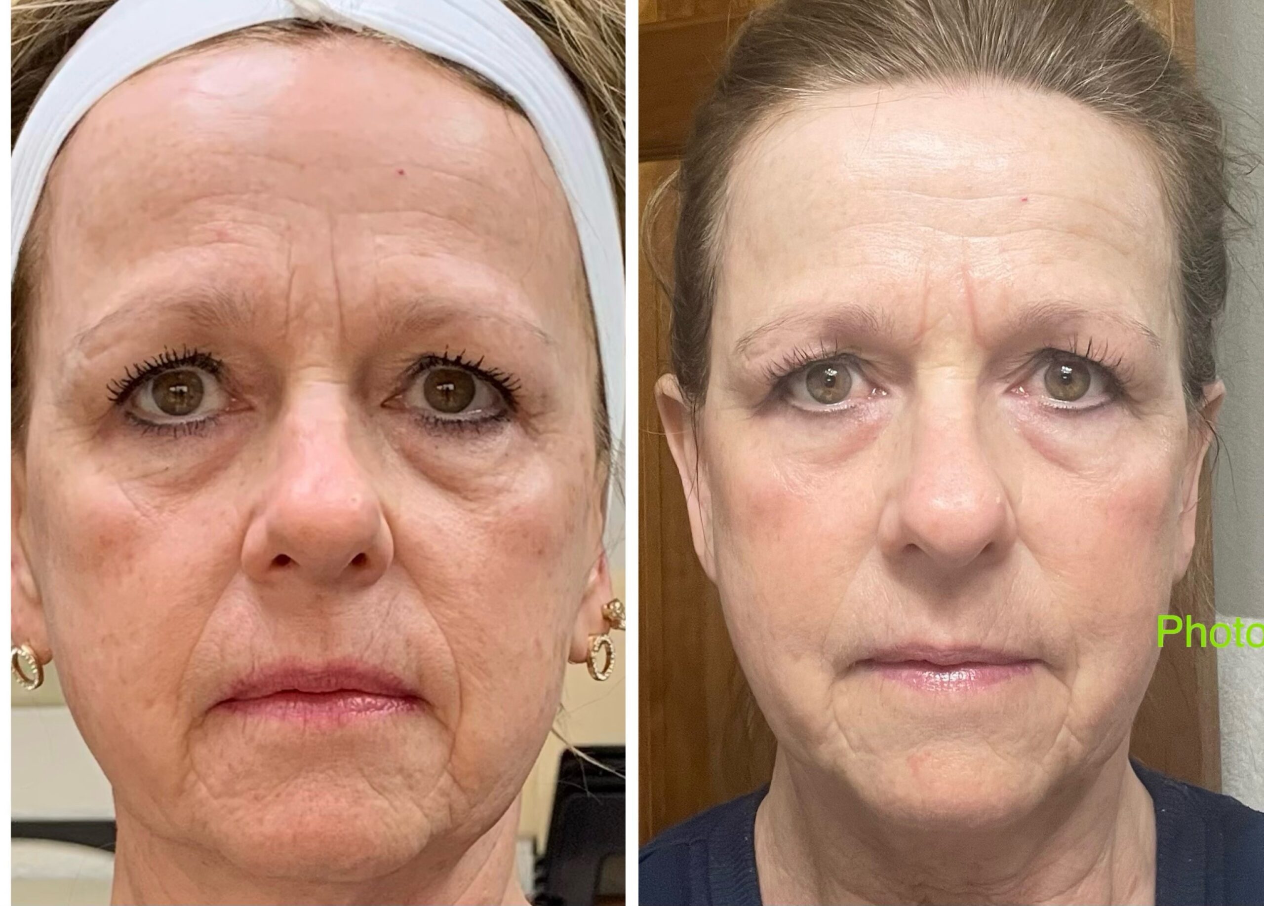 Before And After Plasma Skin Tightening