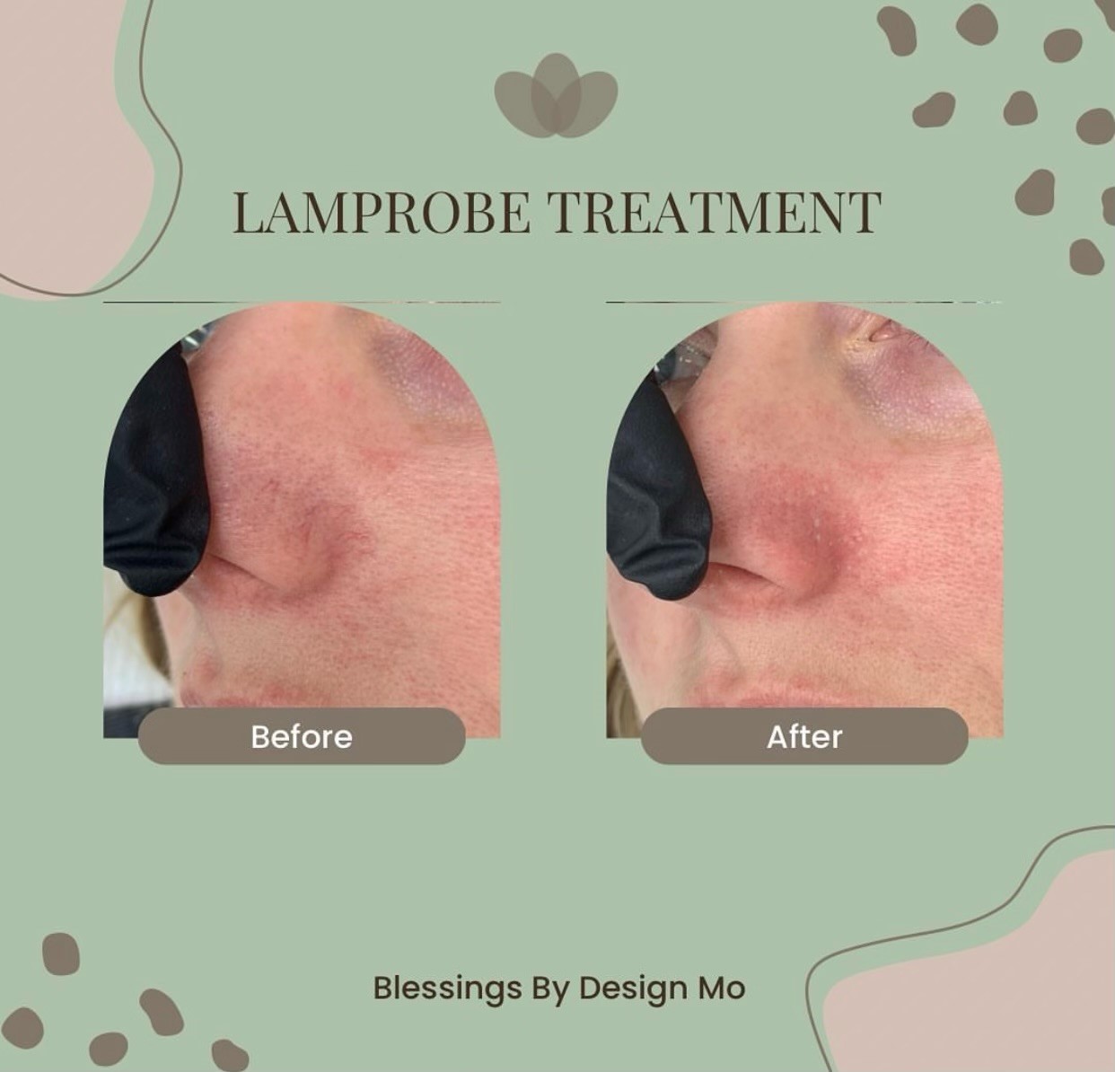 Lamprobe Treatment Before And After