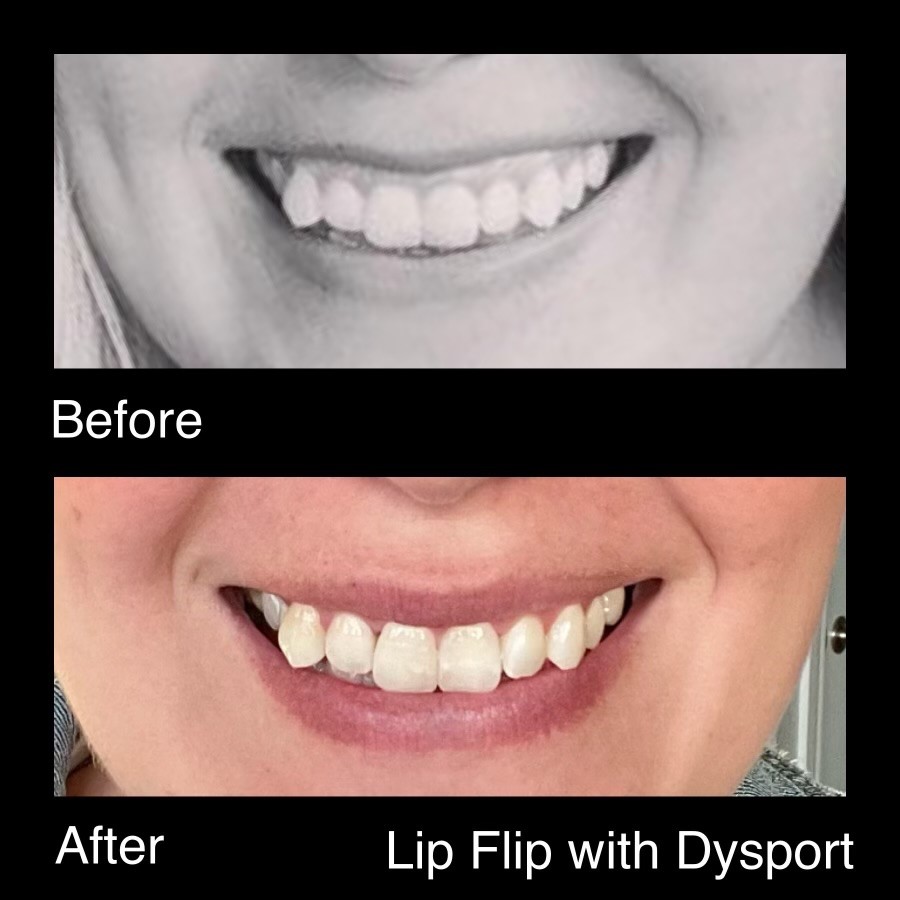 Lip Flip With Dysport Before And After