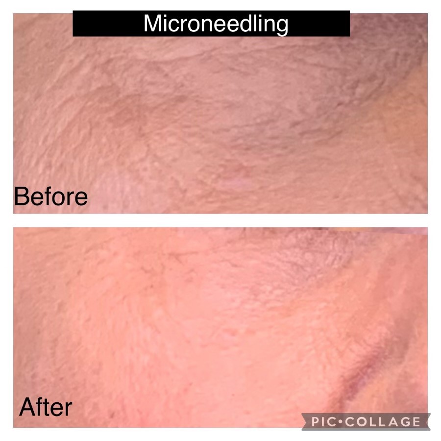 Microneedling Before And After